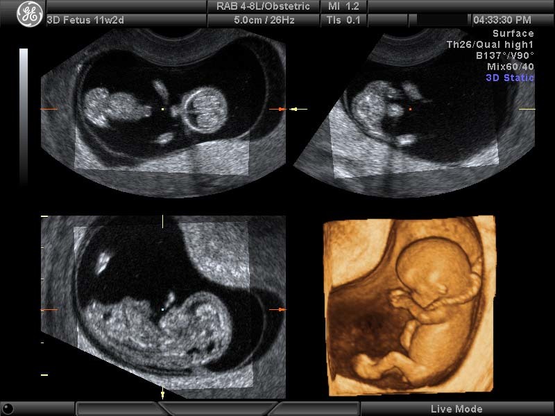 12 недель и 2 дня. УЗИ 13 недель беременности мальчик. УЗИ 13-14 недель беременности мальчик. УЗИ 13-14 недель беременности пол ребенка. УЗИ 11 недель беременности мальчик.